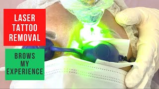 Laser Tattoo Removal Eyebrows My experience full treatment healing process [upl. by Nylloh877]