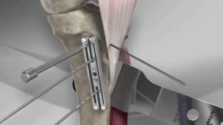 Tibial Tubercle Osteotomy [upl. by Anitahs]