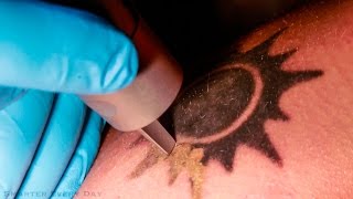 How Laser Tattoo Removal Works  Smarter Every Day 123 [upl. by Orv]