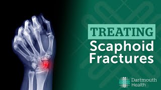 Olecranon  Fracture Fixation Using Tension Band Wiring [upl. by Lifton576]