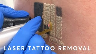 Laser Tattoo Removal PAIN RESULTS amp PROCEDURE [upl. by Engapmahc348]