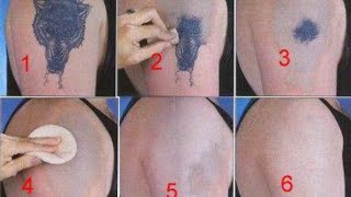 How to Remove a Tattoo without Laser at Home [upl. by Olav]