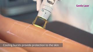 Laser Hair Removal  Candela GentleMax Pro [upl. by Ahsirt]