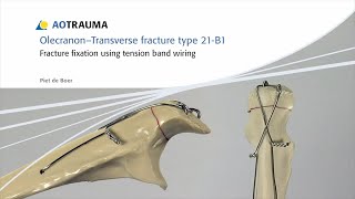 Proximal humeral fracture greater tuberosity [upl. by Sualocin515]