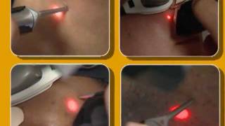 Laser Hair Removal video by Cynosure [upl. by Eaver62]