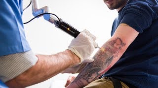 Tattoo Removal Laser Surgery [upl. by Atnad738]