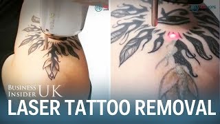 This is how laser tattoo removal works [upl. by Hiroko535]