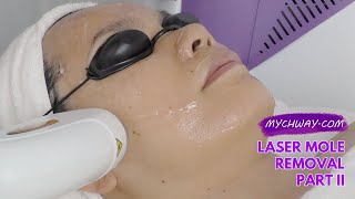 Laser Hair Removal Diode Laser Hair Removal 808nm Laser Painless myChway GX002 Part II Face [upl. by Anirazc815]