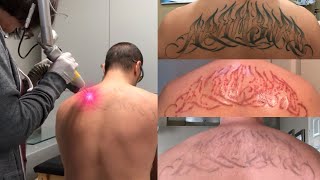 Laser Tattoo Removal  The Ugly Truth [upl. by Oirrad]